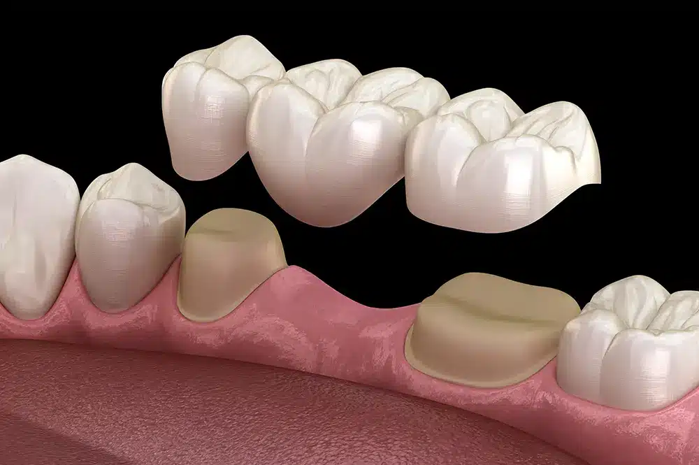 Image showing Dental Teeth Bridges