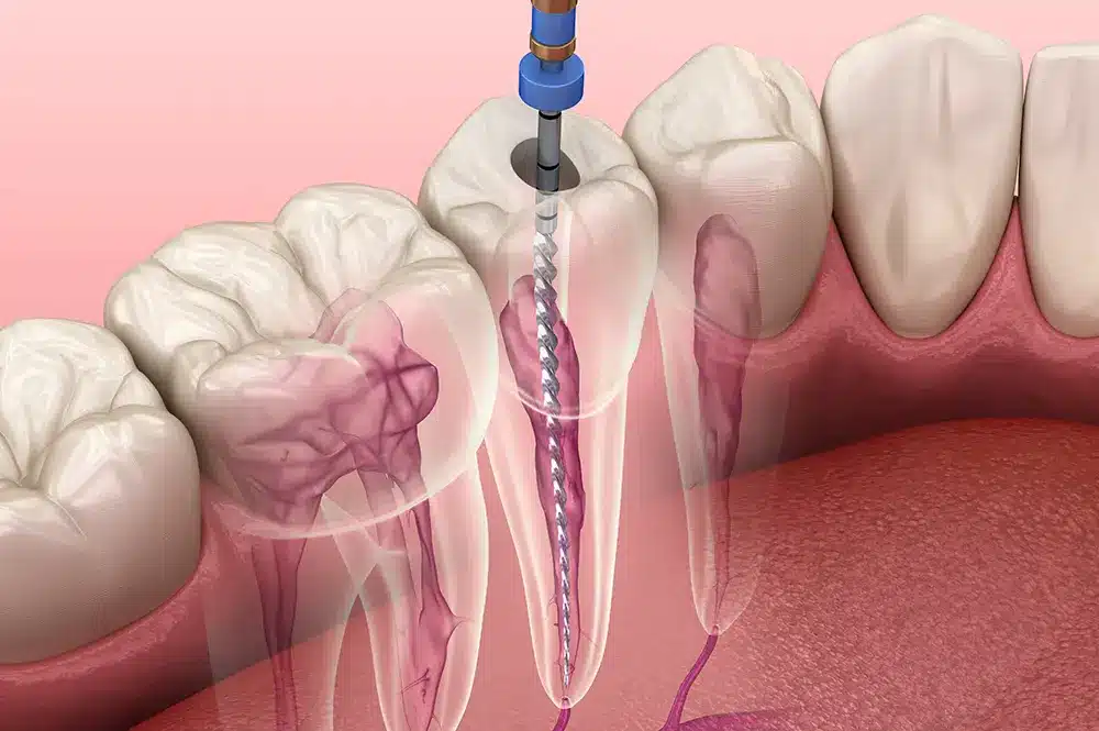 Image showing Dental Tooth Root Canal