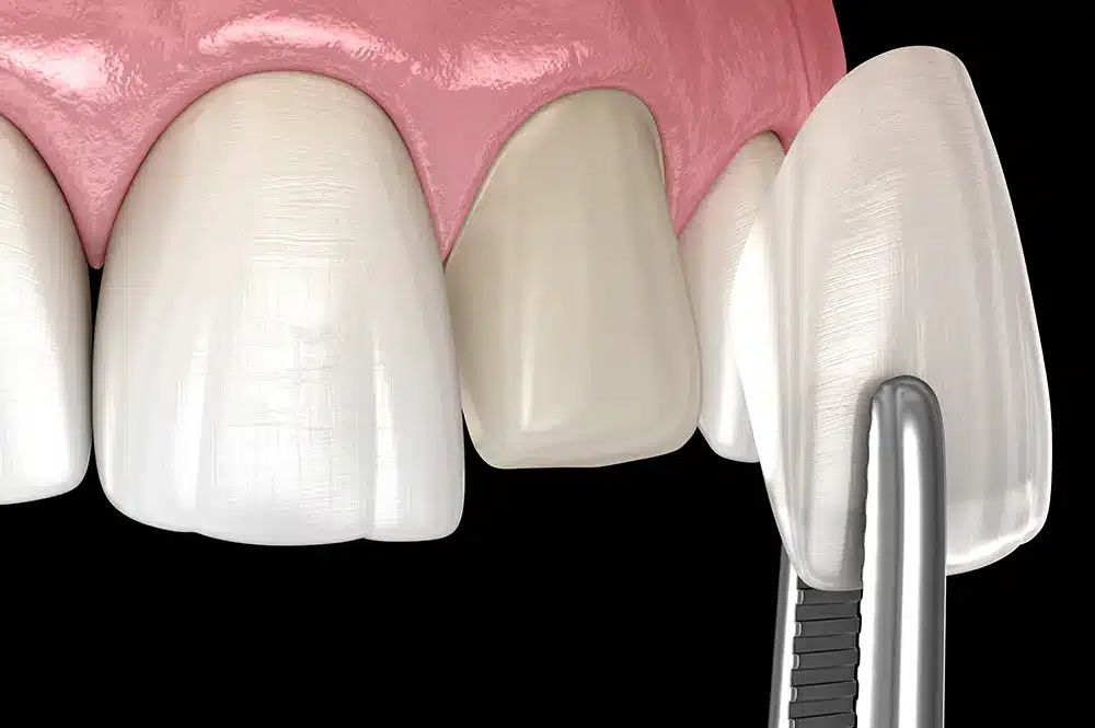 Image showing Dental Teeth Veneers