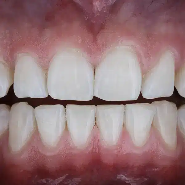 Patient teeth photo after dental procedure